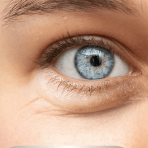 Dark Circles And Puffiness