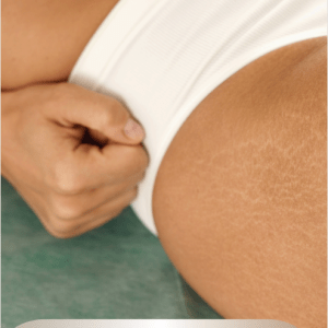 Stretch Marks